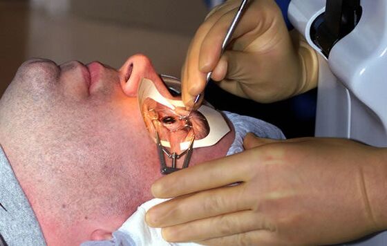Consolidation shaping for nearsighted people to stabilize vision