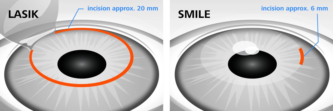 Compare LASIK and SMILE laser vision correction methods